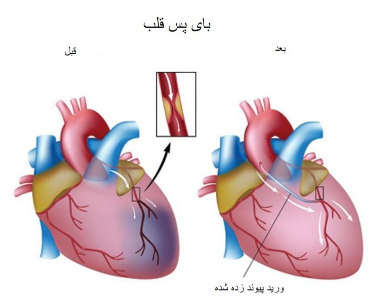 جراحي عروق كرونر